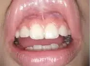 Después — frenilectomía: tejido cicatrizado, movilidad labial libre