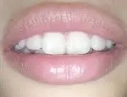 Antes — frenilectomía: frenillo labial restrictivo visible