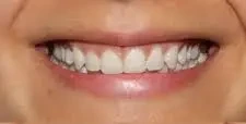 Después — gingivoplastia: línea gingival uniforme y simétrica