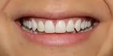 Antes — gingivoplastia: exceso de tejido gingival, sonrisa asimétrica