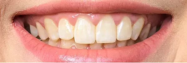Después — blanqueamiento láser: dientes notablemente más blancos