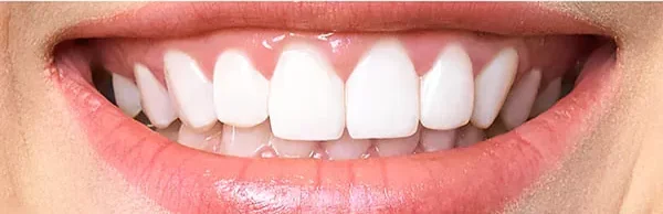 Antes — blanqueamiento láser: dientes con manchas por café y tabaco